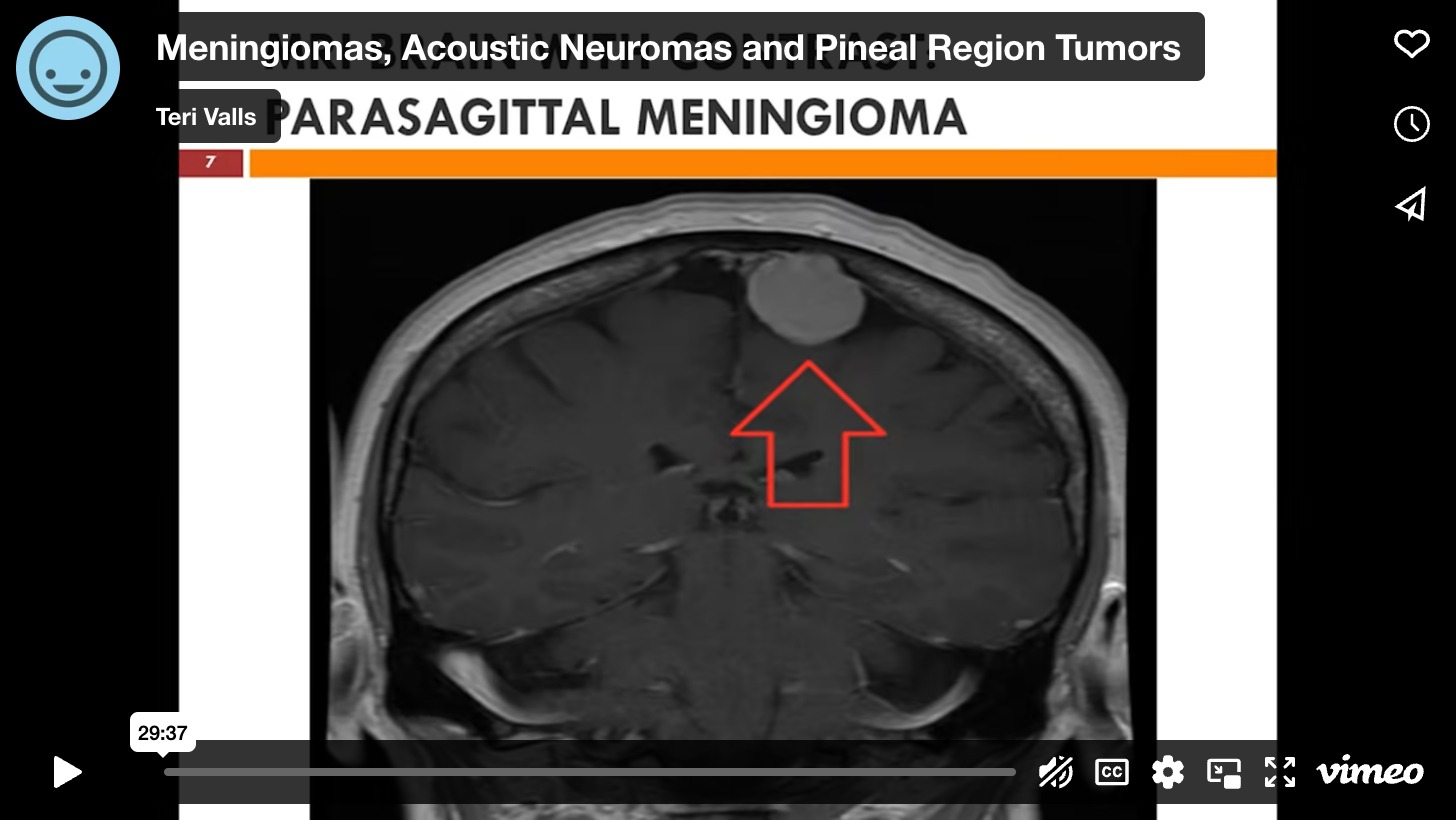 Meningiomas, Acoustic Neuromas and Pineal Region Tumors