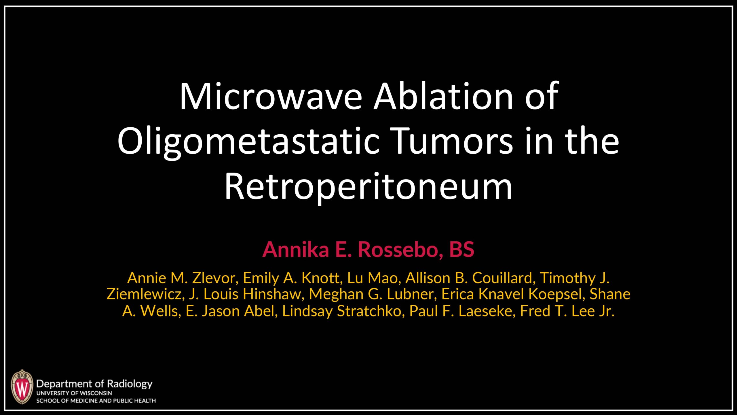 Microwave Ablation of Oligometastatic Tumors in the Retroperitoneum