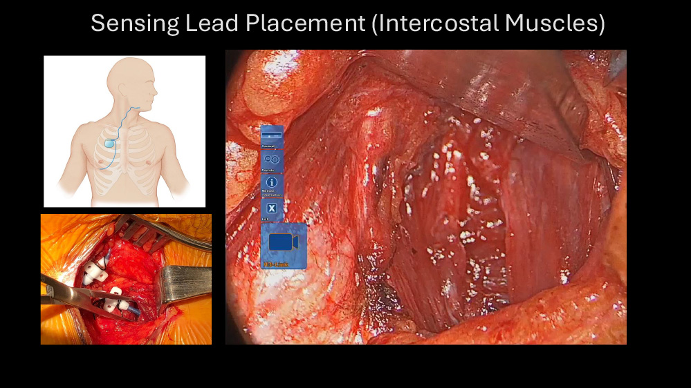 Obstructive Sleep Apnea, Patient Selection, Review of Nonsurgical and Surgical Options, and Surgical Techniques (Part 2)