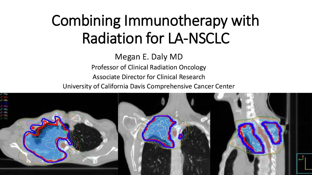 Combining Immunotherapy with Radiation for LA-NSCLC